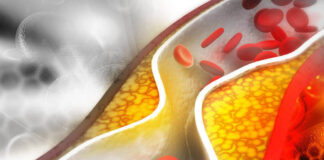 Kötü Kolesterol LDL Neden Yükselir? Düşürmek İçin Ne Yapabiliriz?