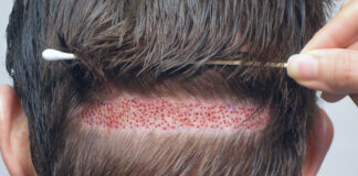 Saç Ekiminde FUE Tekniği Nedir?