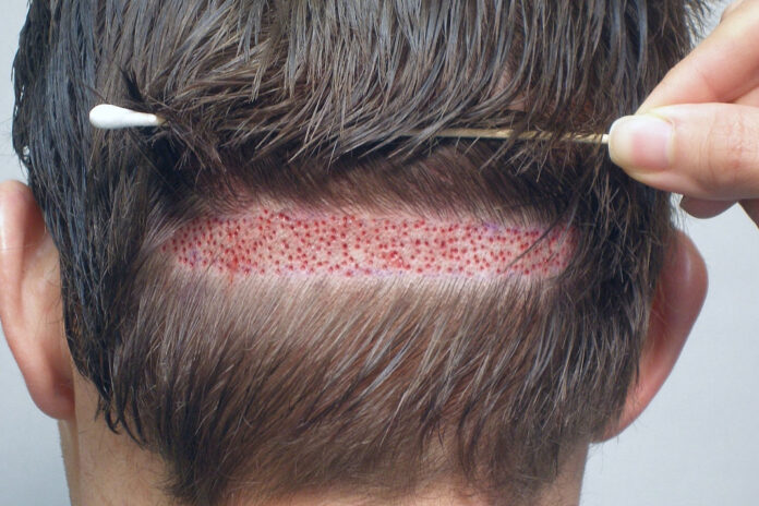 Sac-ekiminde-fue-teknigi-nedir