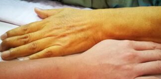 Sarılık Belirtileri Nelerdir? Tedavisi Nasıl Yapılır?