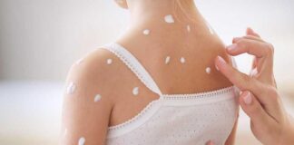 Suçiçeği Belirtileri ve Tedavi Süreci