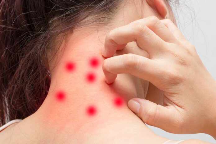 Urtiker-tedavisi-hakkinda-bilinmesi-gerekenler