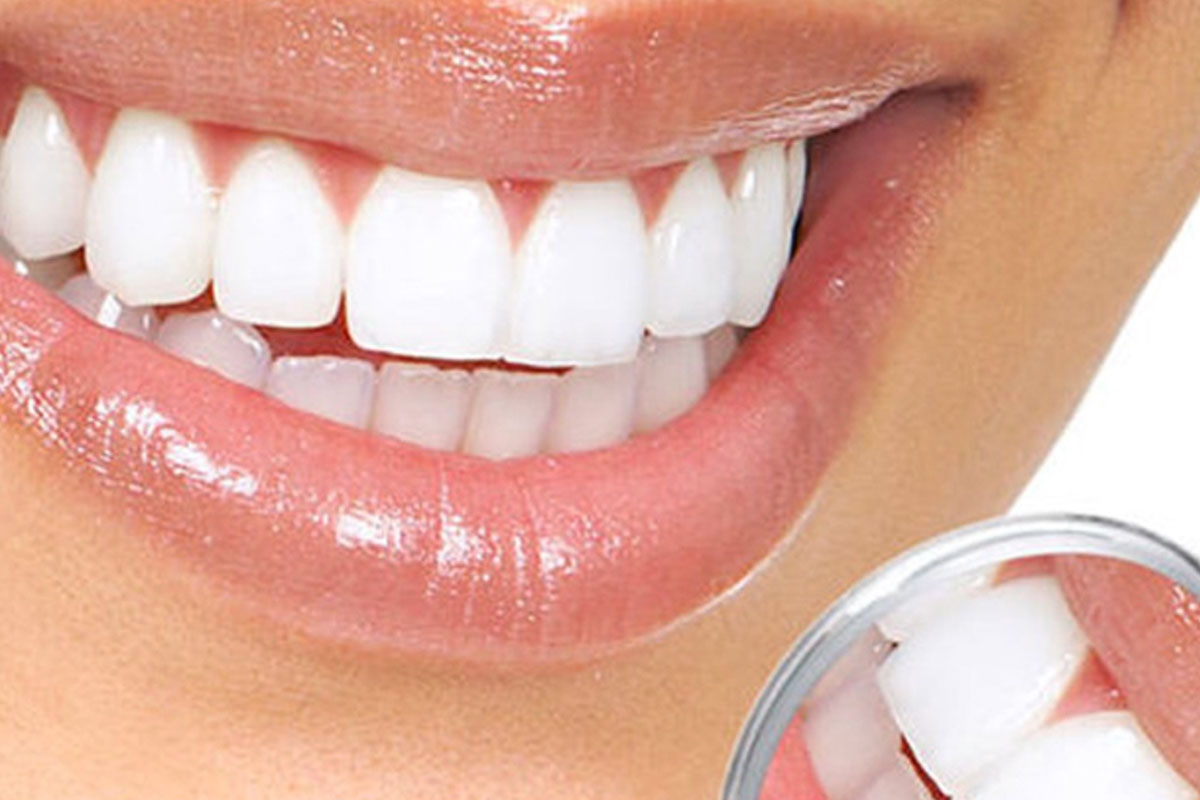 Evde Diş Beyazlatma Yöntemleri Nelerdir? evde dis beyazlatma yontemleri nelerdir 1
