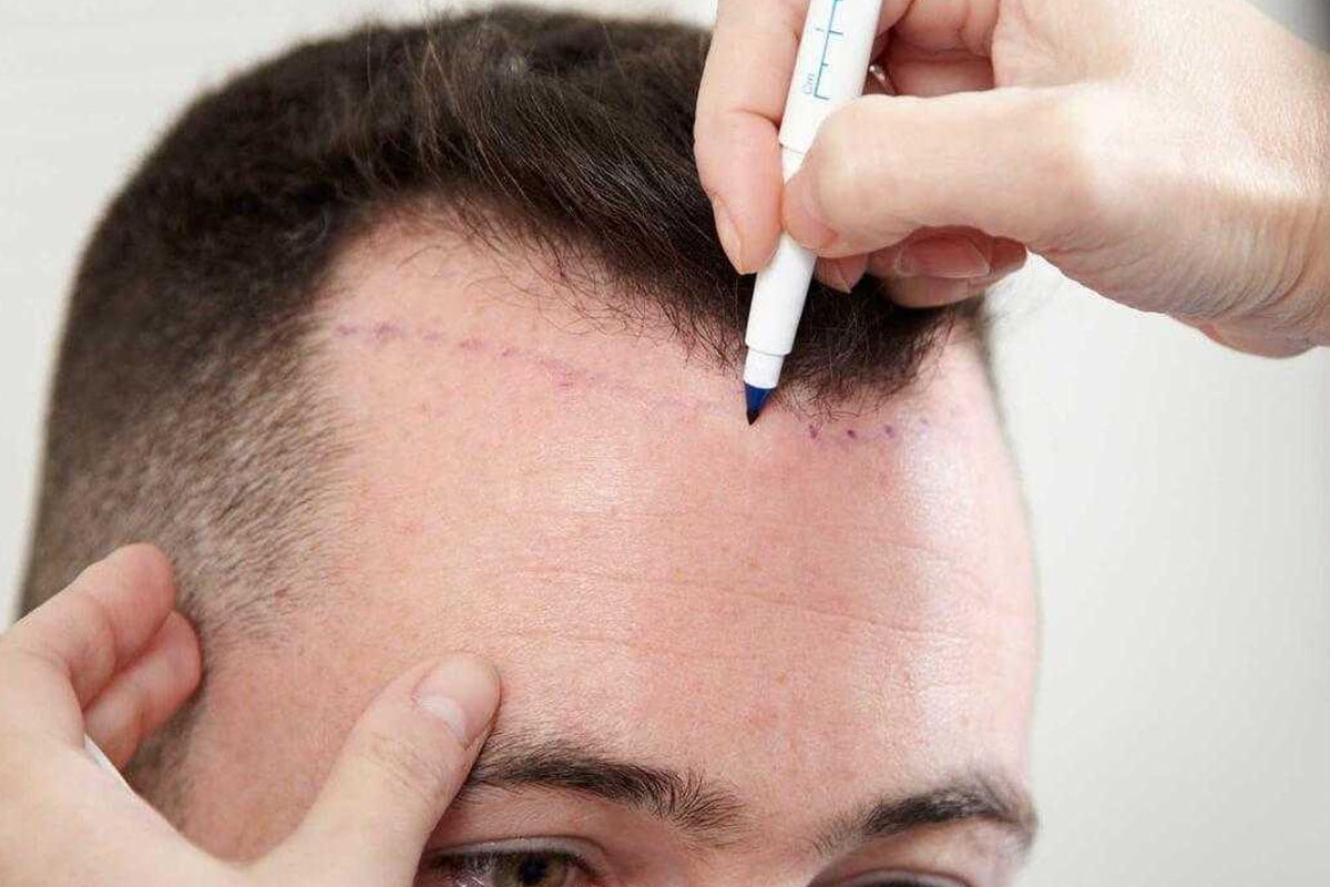 sac ekiminde fue teknigi nedir 1