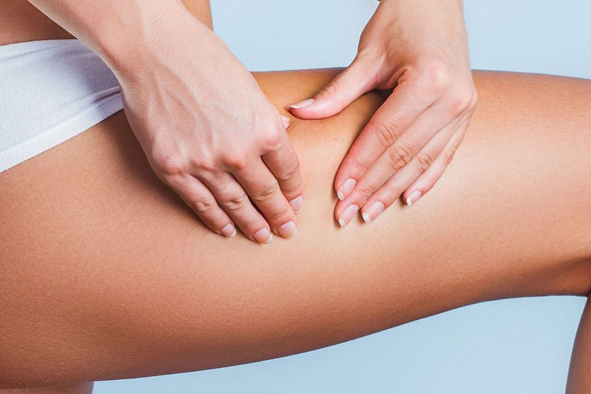 Selülit Neden Olur? Kurtulmak için Ne Yapmak Gerekir? selulit neden olur kurtulmak icin ne yapmak gerekir