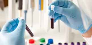 ASO Testi Nedir, ASO Değerleri Ne Olmalıdır?