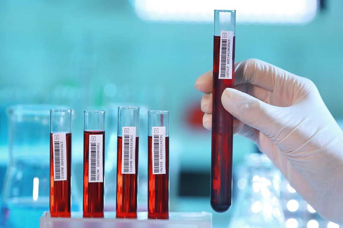 ASO Testi Nedir ASO Degerleri Ne Olmalidir1