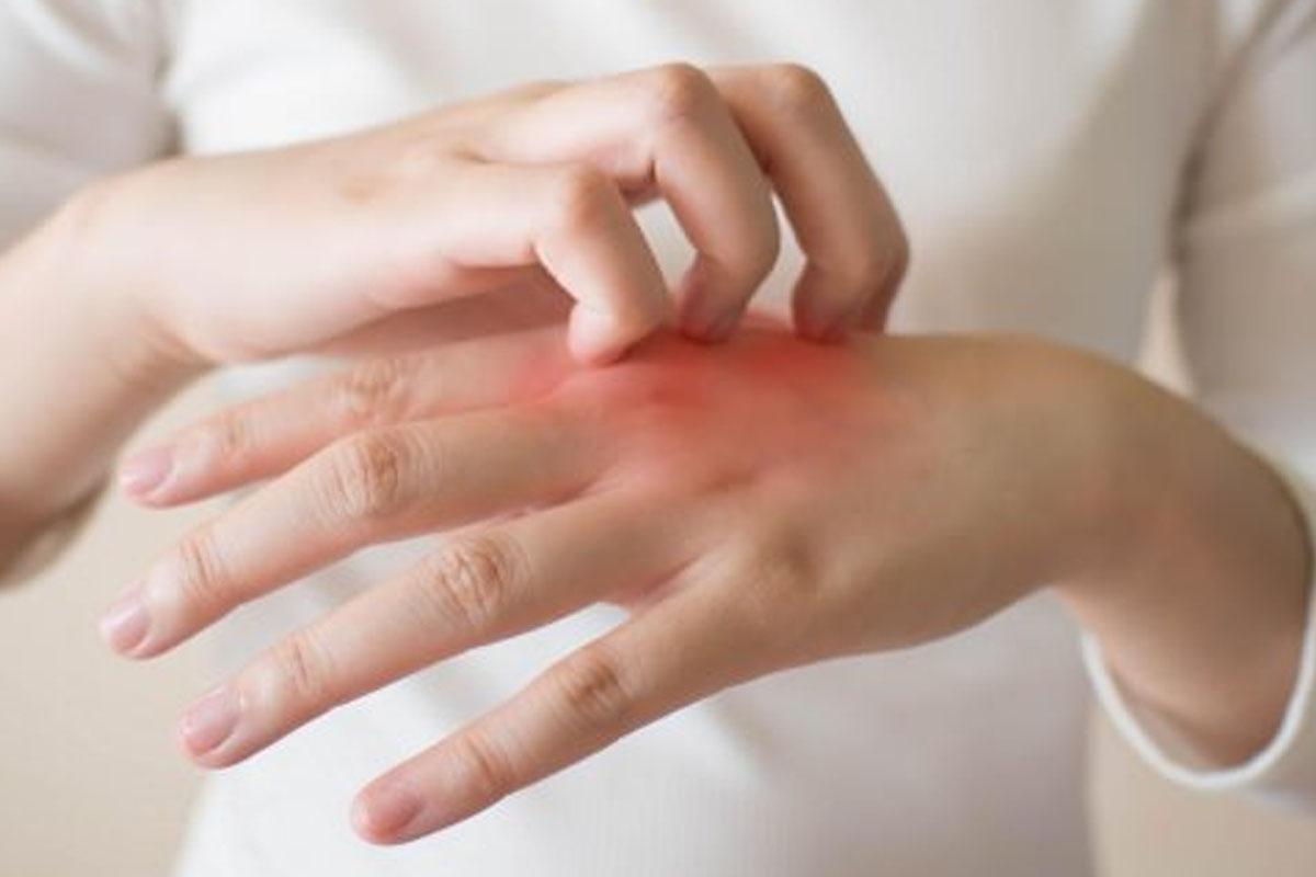 Denizanası Çarpması Tedavisi Nasıl Yapılmalıdır? Denizanasi Carpmasi Tedavisi Nasil Yapilmalidir 1