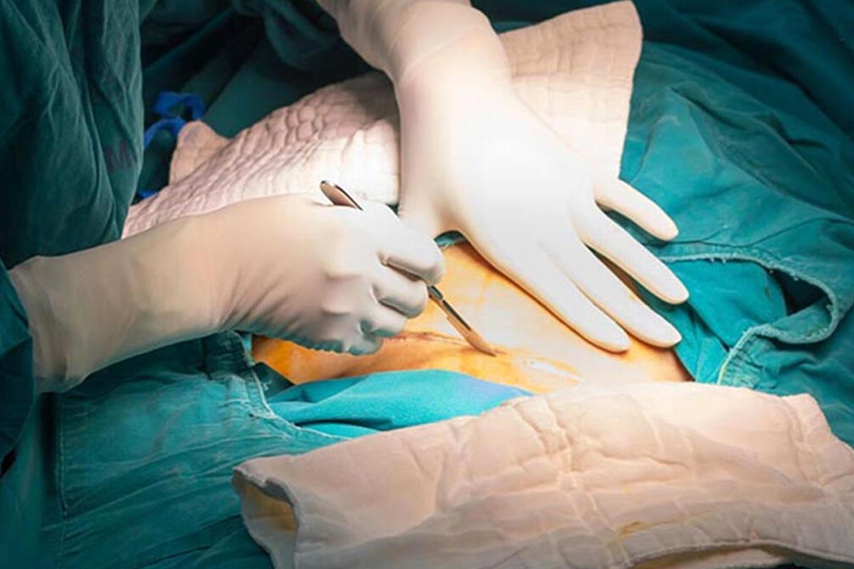 Sezaryen Ile Dogumun Zararlari Nelerdir