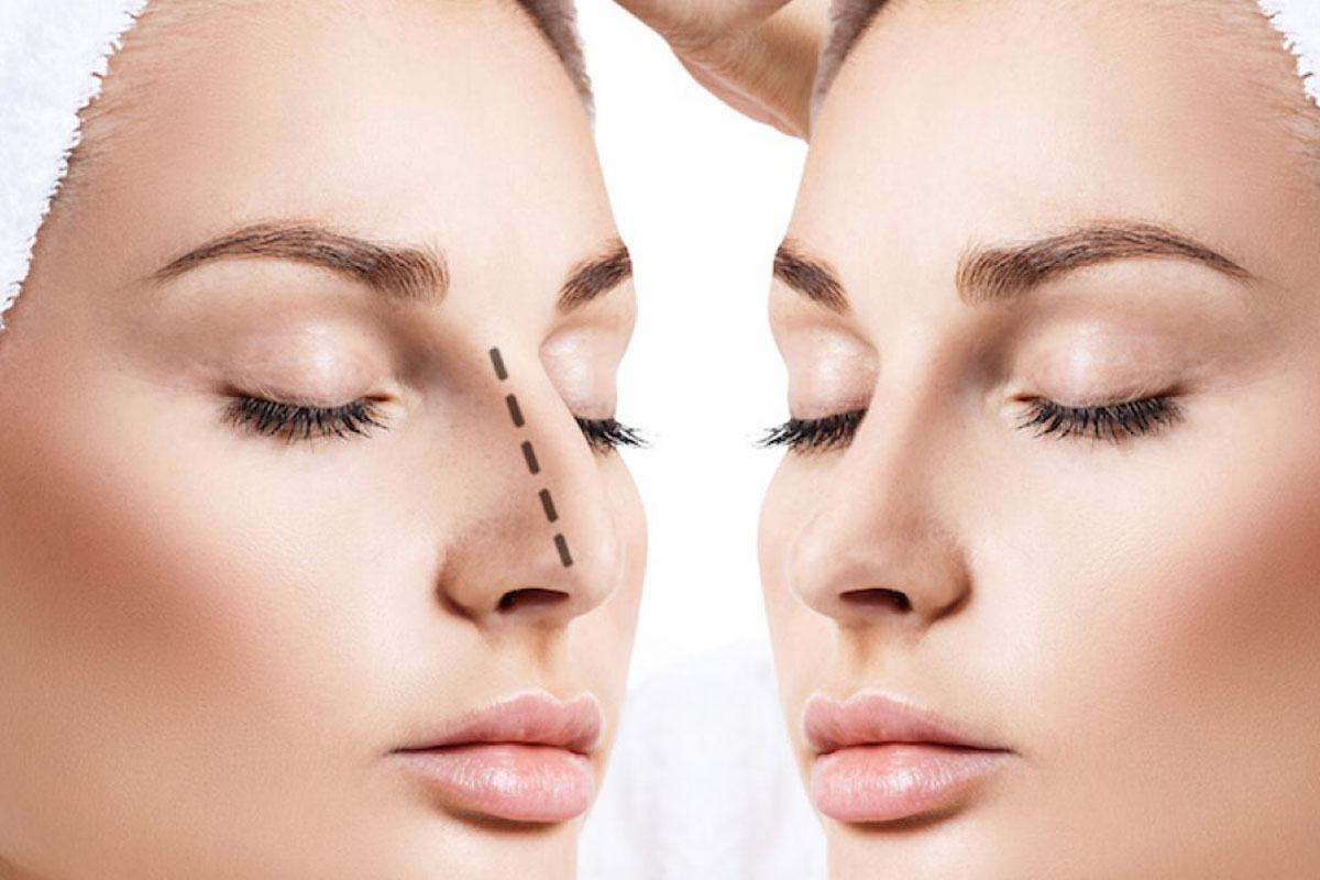 Burun Estetiği Yaptırırken Neye Dikkat Etmeli?