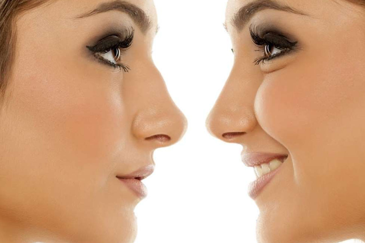 Burun Estetiklerinin Öncesi ve Sonrası